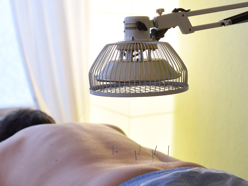 Akupunkturbehandlung am Rücken mit Wärmelampe in der TCM – TCM Heilpraktiker Freiburg